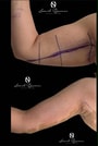 Arm Lift (Brachioplasty Surgery) thumbnail