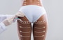 Brazilian Butt Lift (BBL) thumbnail