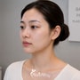 Double Jaw Surgery Package in Gangnam, South Korea – Orthognathic Facial Correction thumbnail