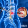 Percutaneous Endoscopic Lumbar Discectomy (PELD) Package in Istanbul Turkey by Biruni Hospital thumbnail