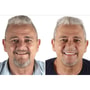 Zygomatic Implants Full Arch Package in Blumenau, Brazil thumbnail