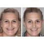All-on-6 Fixed Full Arch Package in Blumenau, Brazil thumbnail