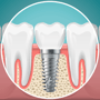 Low-Cost Dental Implants Los Algodones, Mexico thumbnail