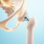 Hip Replacement Package by Group Florence in Istanbul, Turkey thumbnail