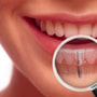 Dental Implant Package in San Jose, Costa Rica by American Dental Care thumbnail