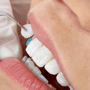 Dental Veneers at Americas Dental Care Costa Rica thumbnail