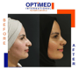Nose Surgery Package in Istanbul Turkey at Optimed Hospital thumbnail