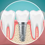 Dental Implants in Colombia - Affordable Tooth Replacement thumbnail