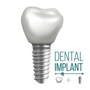 Dental Implants Package in Bangalore India thumbnail