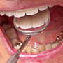 Zirconium Crown and Root Canal Package in Los Algodones Mexico by Rancherito Dental thumbnail