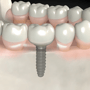 Dental Implants in Los Algodones, Mexico - Package Price $750 thumbnail
