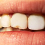 Dental Veneers Package in Los Algodones Mexico thumbnail