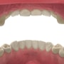 All-Inclusive Package For Dental Bridges in Mexico thumbnail