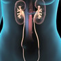 Cost-Effective Kidney Stone Removal Package in Mexicali, Mexico by Ricardo Garcia thumbnail