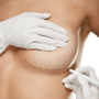 Low-Cost Package for Breast Lift with Implants in Mexico thumbnail
