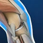 Top Package for Meniscus Repair in Nuevo Laredo, Mexico thumbnail