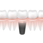 Cheap Package for Dental Implants in Cancun, Mexico thumbnail