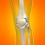 Most Desired Meniscus Arthroscopic Surgery in Puerto Vallarta, Mexico thumbnail