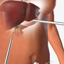 Laparoscopic Solutions Gallbladder Surgery Package in Piedras Negras, Mexico thumbnail