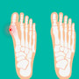 Hallux Valgus / Bunionectomy Surgery with LAPIDUS 3D Technology in Istanbul, Turkey thumbnail