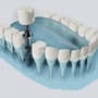Top Package for Dental Implants in Medellin, Colombia thumbnail