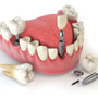 All on 4 Dental Implants Package in Tijuana, Mexico by Quality International Dental Clinic thumbnail