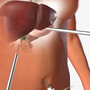 Laparoscopic Gallbladder Removal Surgery Package in Cancun, Mexico by Costamed thumbnail