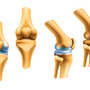 Orthopedics Regenerative Medicine in Florida Plantation, USA thumbnail