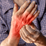 Stem Cell Therapy for Psoriasis Package in Monterrey, Mexico by Stem Solutions thumbnail