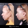 Neck Lift Package in Seoul, South Korea by VG Plastic Surgery thumbnail