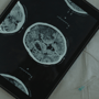 Stem Cell Therapy for Brain Injury Mexico | Tijuana | Cost thumbnail