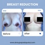 Breast Reduction Package at Dr. Ary Papadopulos - Plastic Surgery in Mexico City, Mexico City, Mexico thumbnail