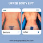 Upper body Lift Package at Dr. Ary Papadopulos - Plastic Surgery in Mexico City, Mexico City, Mexico thumbnail