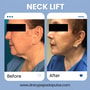 Neck Lift Package at Dr. Ary Papadopulos - Plastic Surgery in Mexico City, Mexico City, Mexico thumbnail