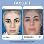 Premium Facelift Mexico Package at $12,500 by Dr. Papadopulos thumbnail