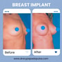 Breast Implants Package at Dr. Ary Papadopulos - Plastic Surgery in Mexico City, Mexico City, Mexico thumbnail