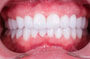 Full Mouth Implantation  thumbnail