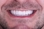 All on 4 Dental Implants Package at DentSpa thumbnail