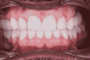 Hollywood Smile - E-max Veneers thumbnail
