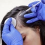 Non-Surgical Stem Cell Hair Restoration Mexico Package at CellsTime Guadalajara thumbnail