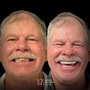 Affordable Dental Implants by Dental Artistry & World Dental Center in Nuevo Progreso, Mexico thumbnail