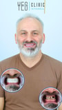 All on 6 Dental Implants Package at YEG Clinic - Best Dental Clinic Istanbul, İstanbul, Turkey thumbnail