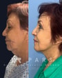 Deep Plane Face Lift Package in Guadalajara, Mexico by PARS thumbnail