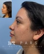 Nose Surgery Rhinoplasty Package at PARS - Plastic, Aesthetic & Reconstructive Surgery in Guadalajara, Mexico, Guadalajara, Mexico thumbnail