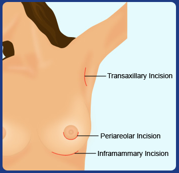 image-breast-augmentation-yanhee-hospital-bangkok-thailand