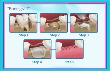 Bone Graft in Mexico Bone Graft in Mexico