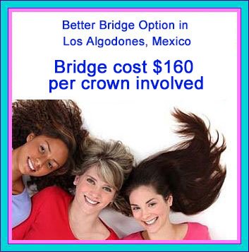 Dental Bridges in Mexico Cost Dental Bridges in Mexico Cost