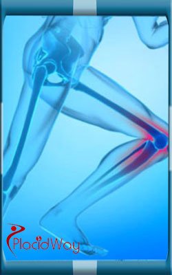 Knee Replacement in India Costs Knee Replacement in India Costs