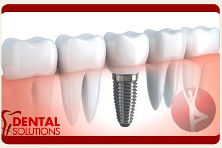 Implant Dentistry in Bangalore India Dental Treatment in Bangalore India