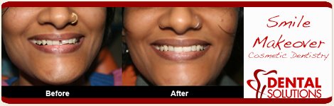 Before and After Smile Makeovers Treatment in India Bangalore